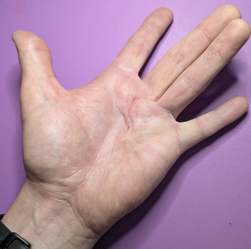 Photo of Si's left hand, the middle finger and ring finger are together as he cannot move them independently, they are raised from the surface the hand is resting on because he cannot flatten his hand due to contracture, and on the palm of his hand you can see lumpy tissue and deep furrows, and the scars from his previous hand surgery. 